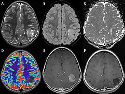 Role of DNA Methylation Profile in Diagnosing Astroblastoma: A Case Report and Literature Review